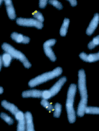 Imagen: Cromosomas con hibridación fluorescente in situ (FISH), mostrando un par de puntos amarillos como áreas de genes que hacen falta debido a la deleción de genes en el cromosoma 22 (Fotografía cortesía de la Universidad de Stanford).